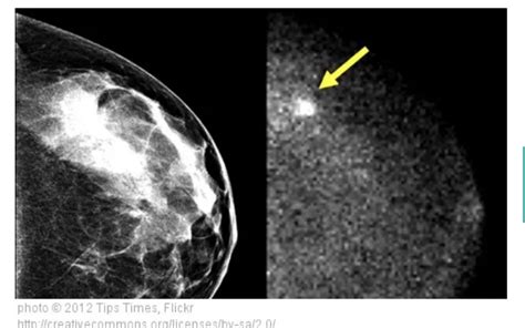 are mammograms free under affordable care act